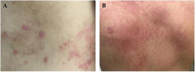 Adult-onset Still’s disease: A disease at the crossroad of innate immunity and autoimmunity